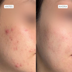 Sérum exfoliante ácido glicólico 4% y láctico 2,5% 30ml